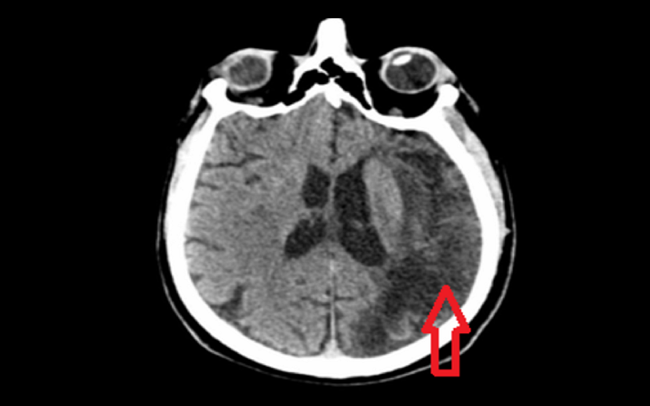Obraz tomografii komputerowej gowy przedstawiajcy rozlege ognisko niedokrwienia w lewej pkuli mzgu 500x500