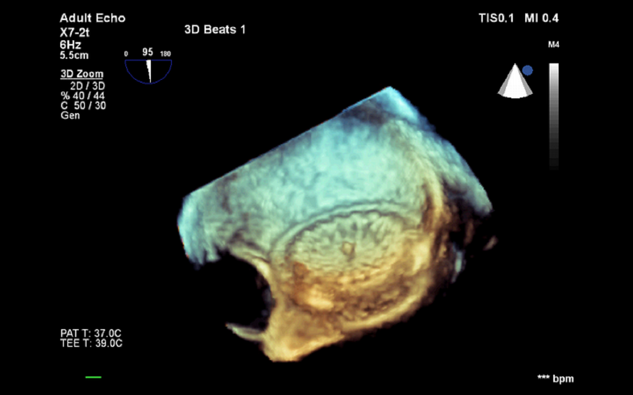  Badanie echokardiograficzne przezprzełykowe trójwymiarowe 3 D u 41-letniej chorej z ubytkiem przegrody międzyprzedsionkowej
