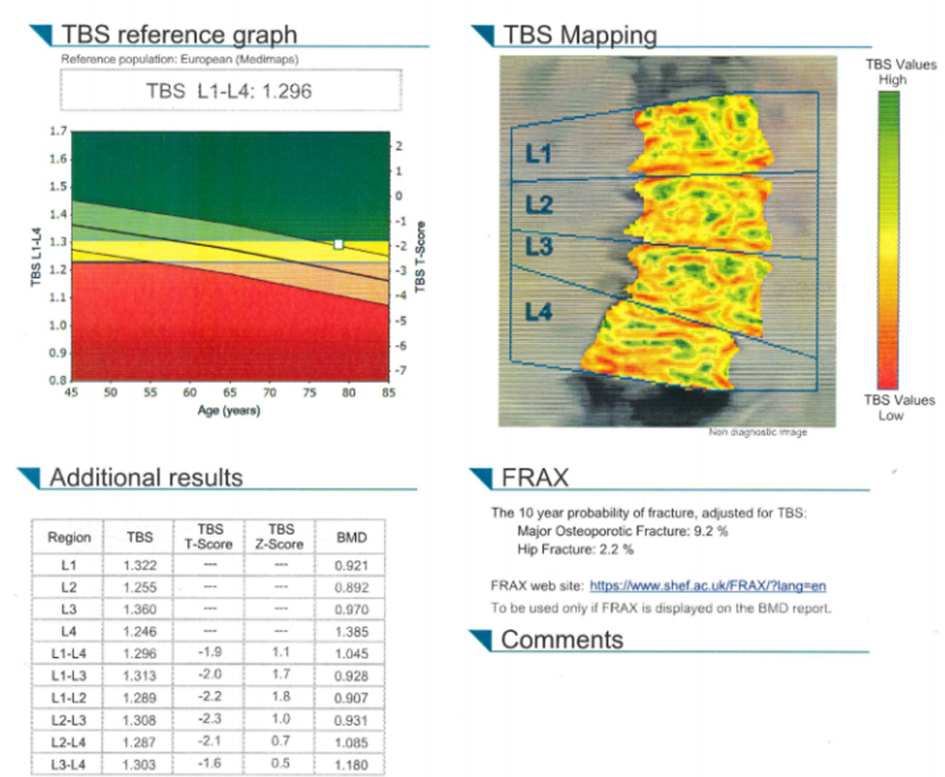 Wynik_badania_DXA_i_TBS_u_78_letniej_pacjentki_ze_złamaniami_kompresyjnymi.png